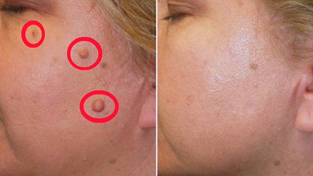 Лечение кожи лица лазером воронеж